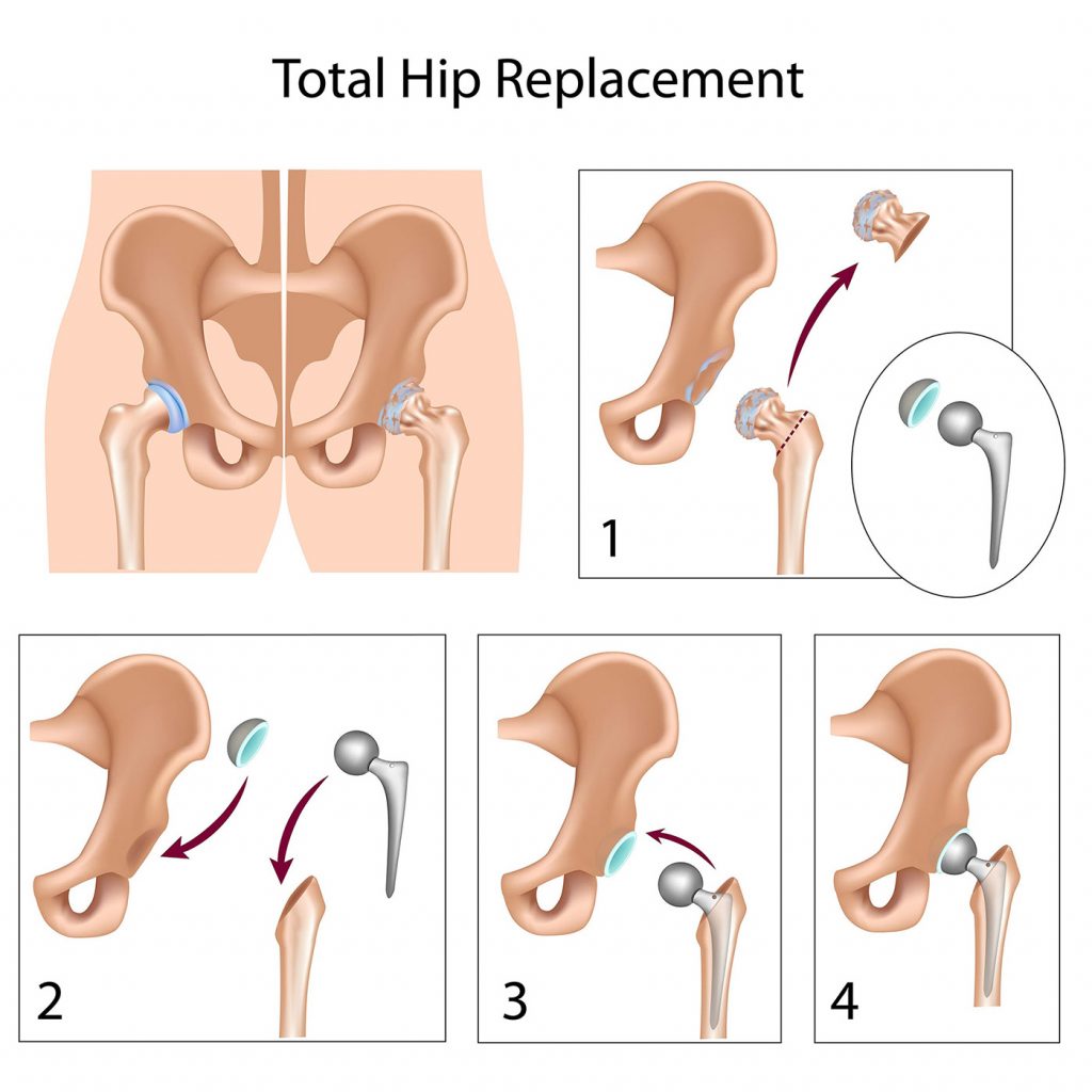 Geriatric Fractures Oxford Orthopaedics Clinic