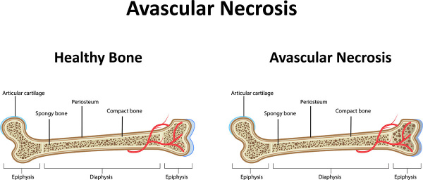 Avascular Necrosis Avn Oxford Orthopaedics Clinic