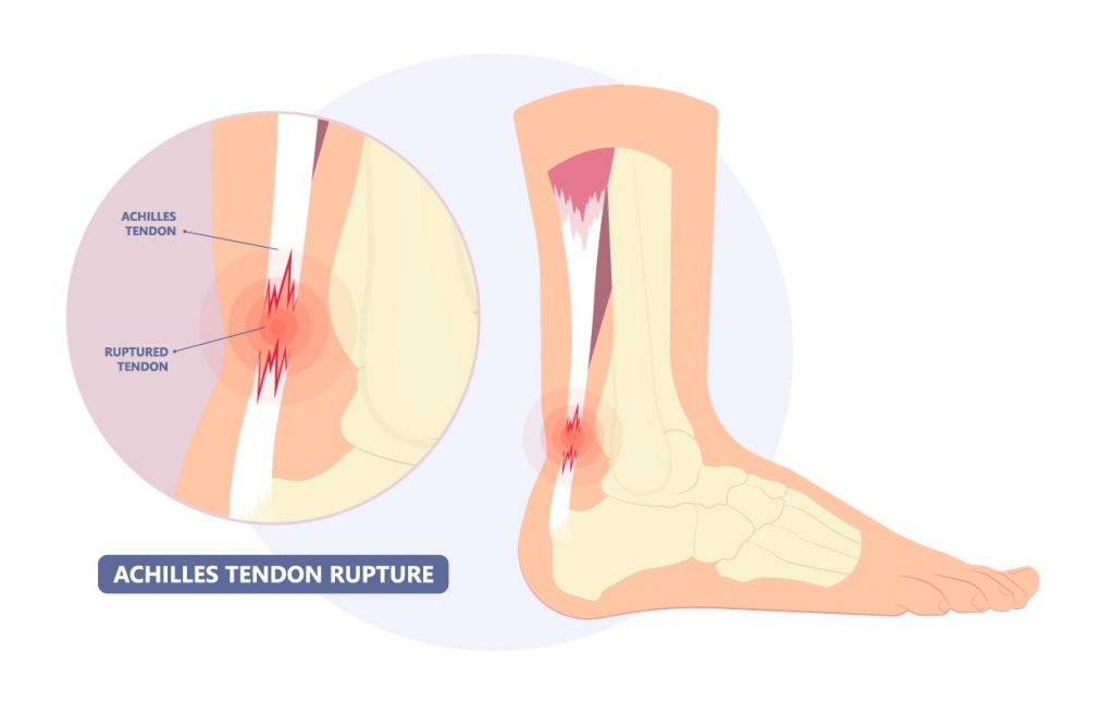 Tendon Injuries - Oxford Orthopaedics Clinic