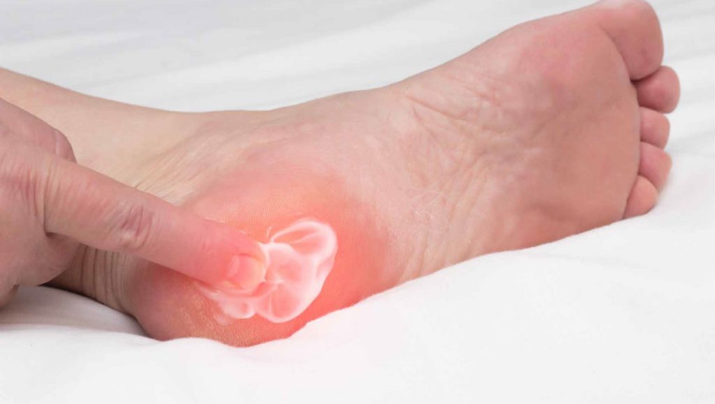 Foot Pain with Fibromyalgia: Growing Correlations