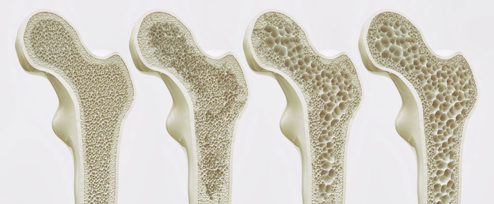 bone-health01
