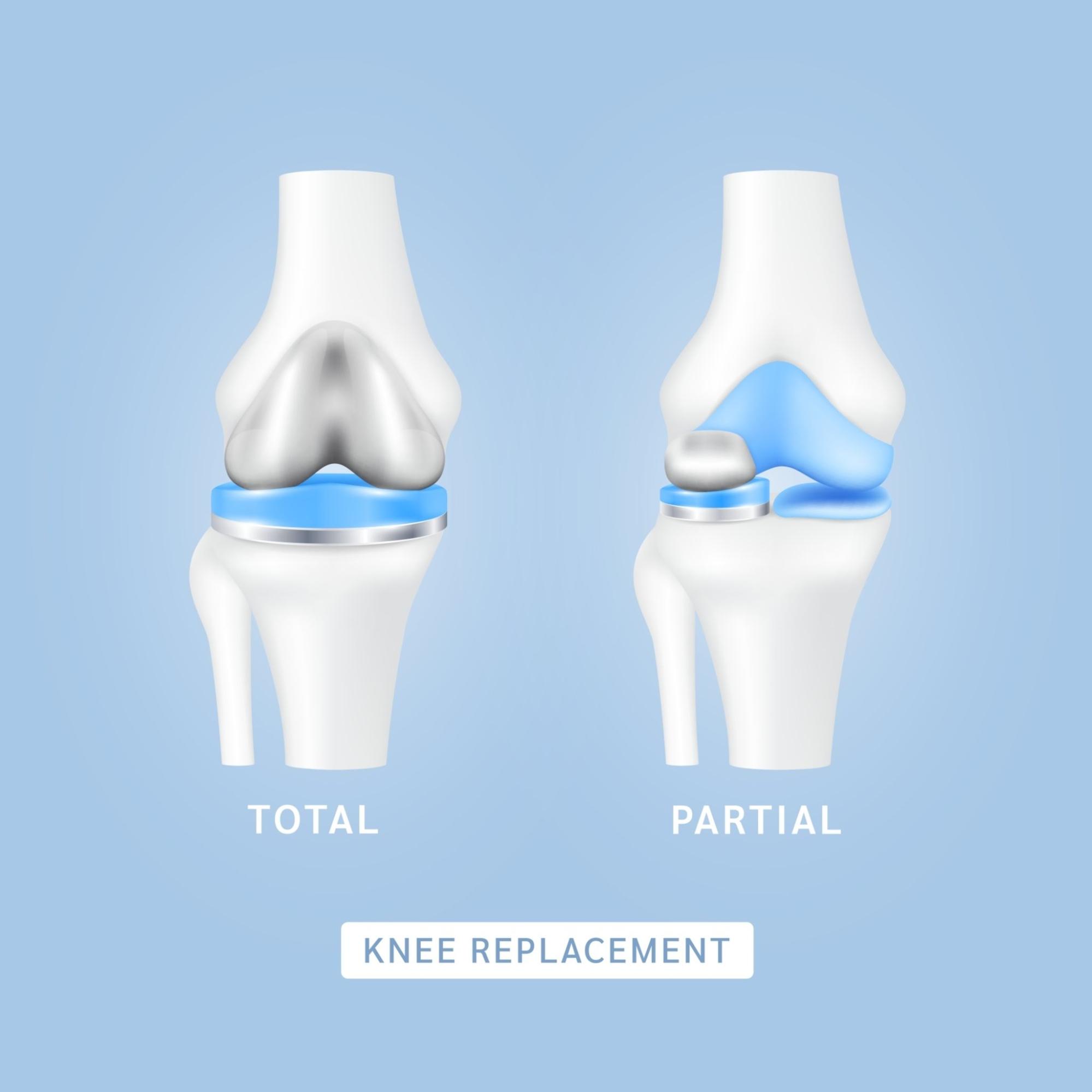 total knee replacement vs partial knee replacement