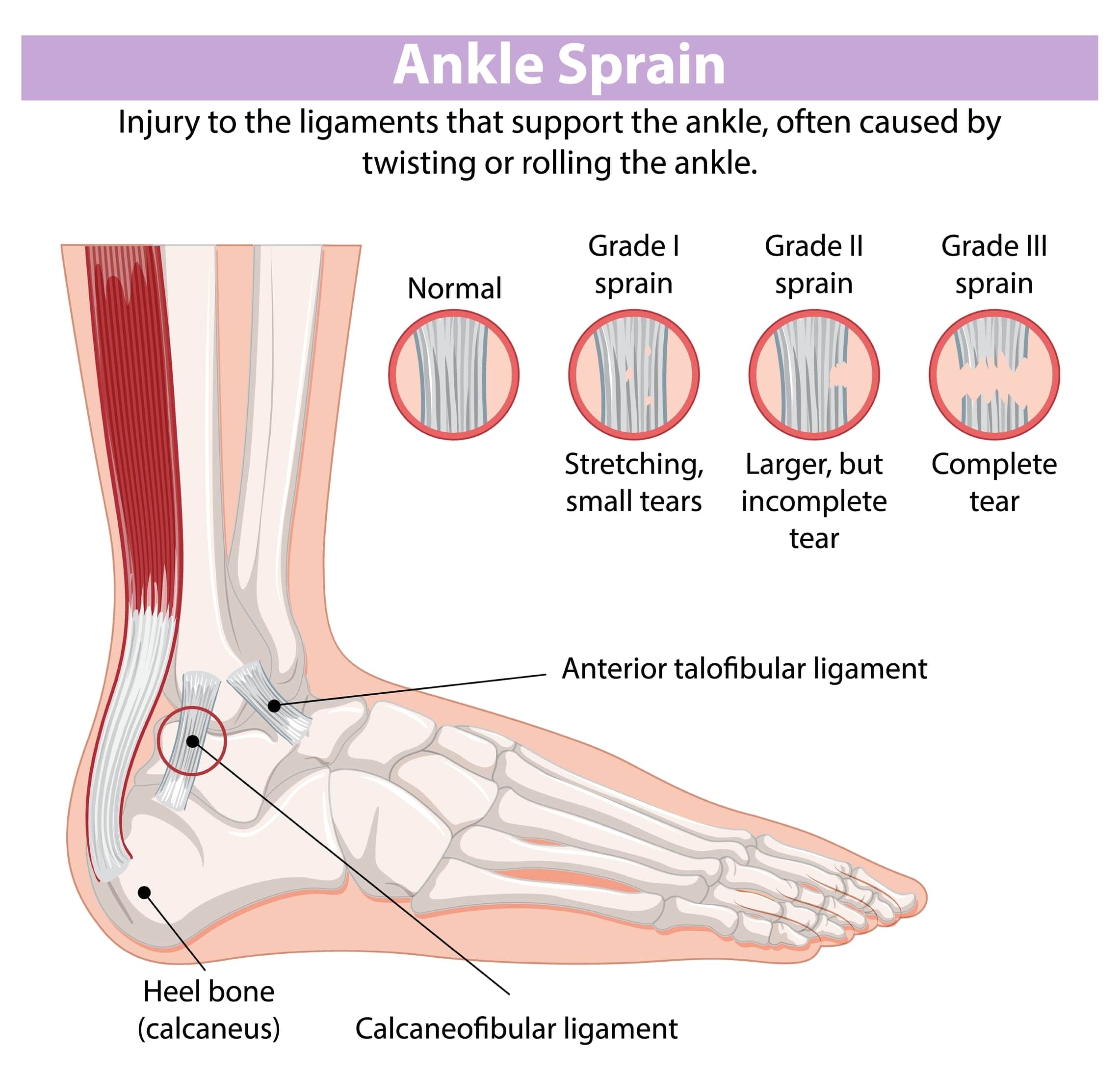 Ankle Sprain Mechanism Of Injury Ankle Sprain Mechanism Of Injury