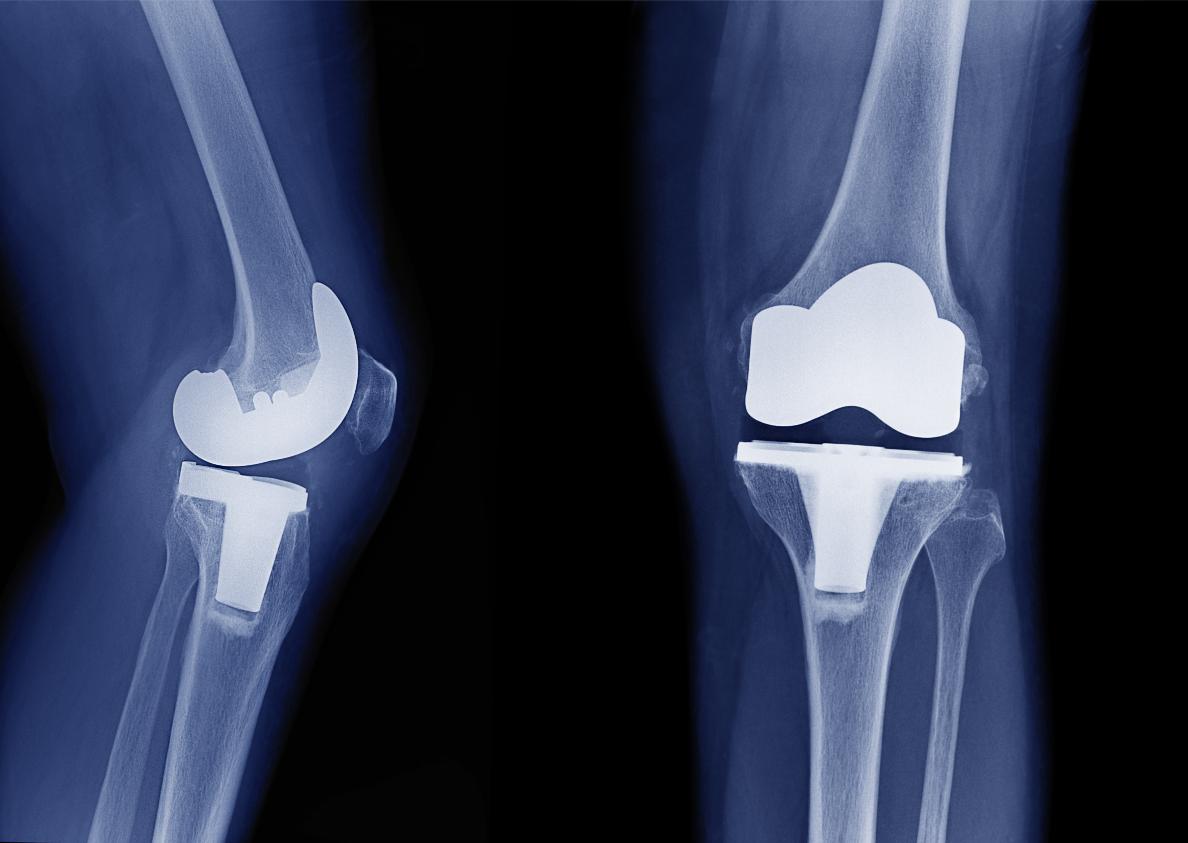 Robotic Total Knee Replacement - Oxford Orthopaedics