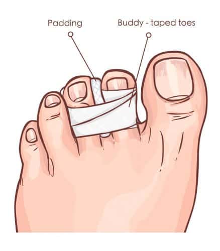 toe fracture diagnosis - Oxford Orthopaedics