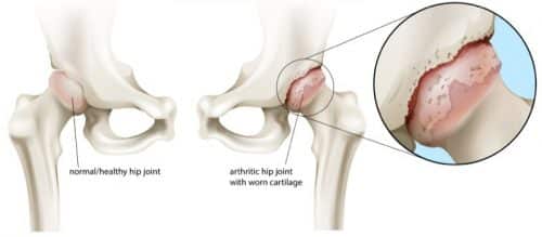 hip arthritis