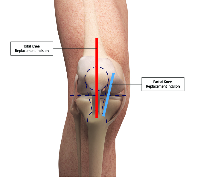 Oxford-Knee-Replacement_Shorter-Incision