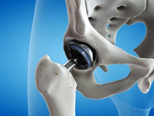 hip replacement surgery singapore - Oxford Orthopaedics
