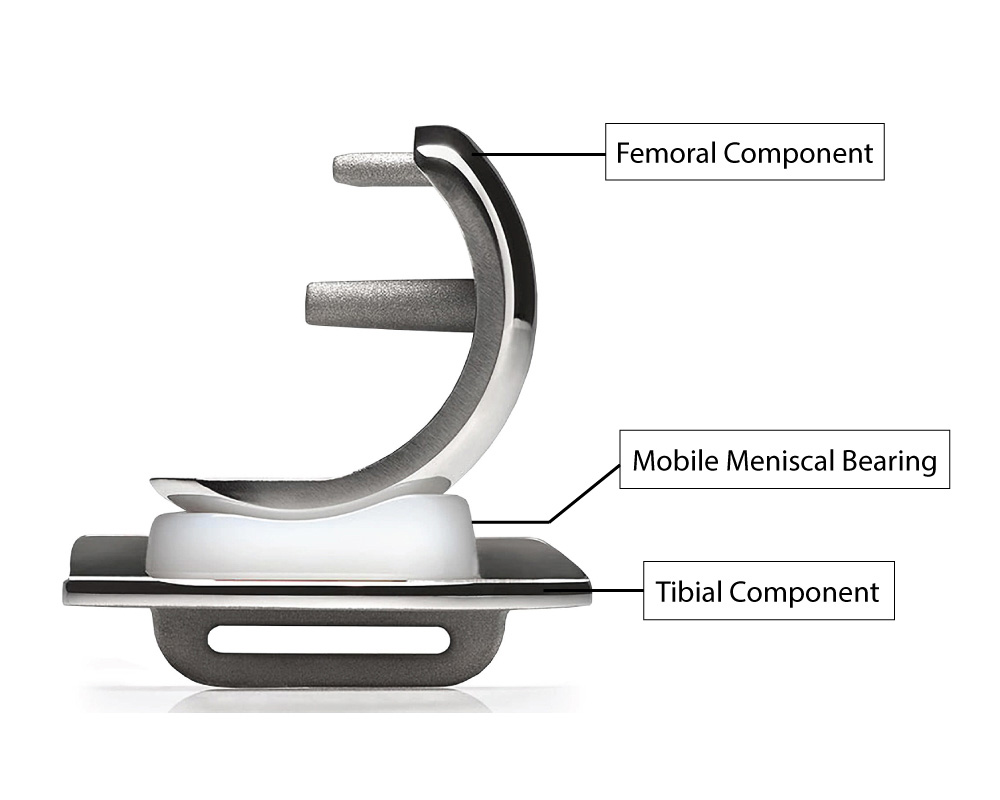 Partial knee replacement - Oxford Orthopaedics