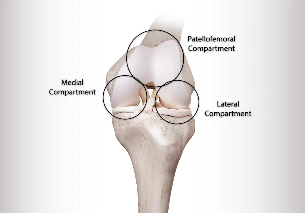 Knee replacement surgery (knee comparments illustration)