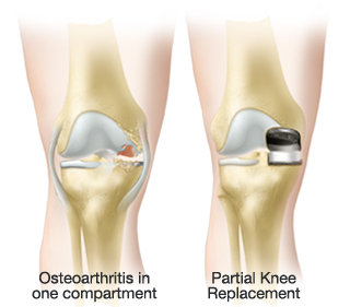 Partial knee replacement surgery - Oxford Orthopaedics