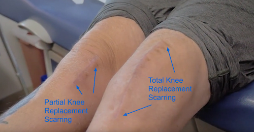 partial knee replacement vs total knee replacement
