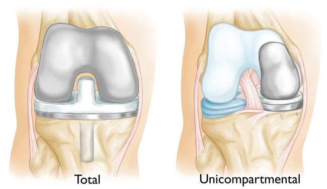 unicompartmental vs total knee replacement