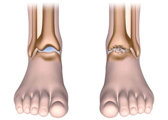 Ankle Osteoarthritis
