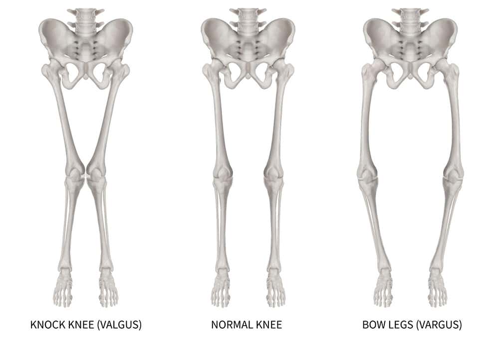 Complex Knee Deformities