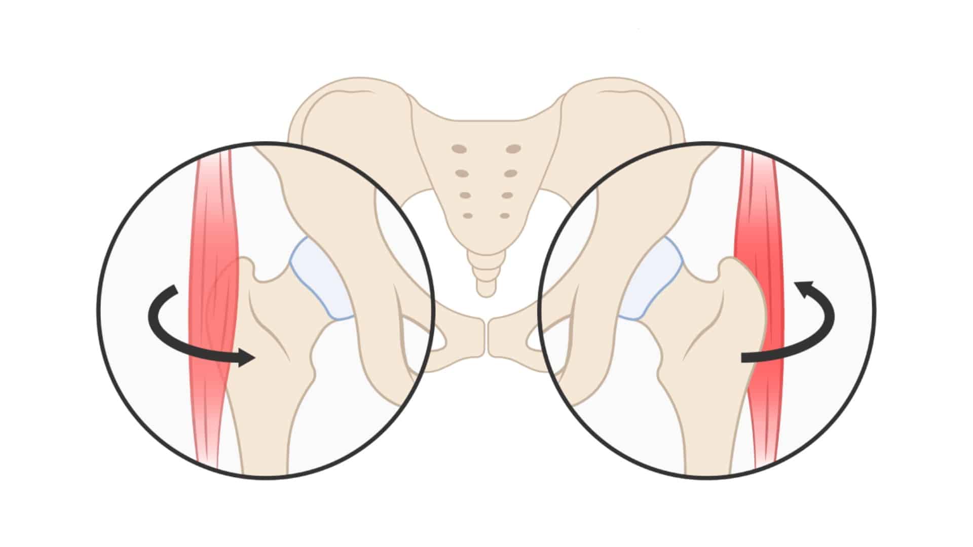 Coxa Saltans Snapping Hip Syndrome (SHS)