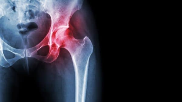 Hip Osteoarthritis diagnosis