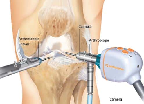 Knee Arthroscopic Keyhole Surgery