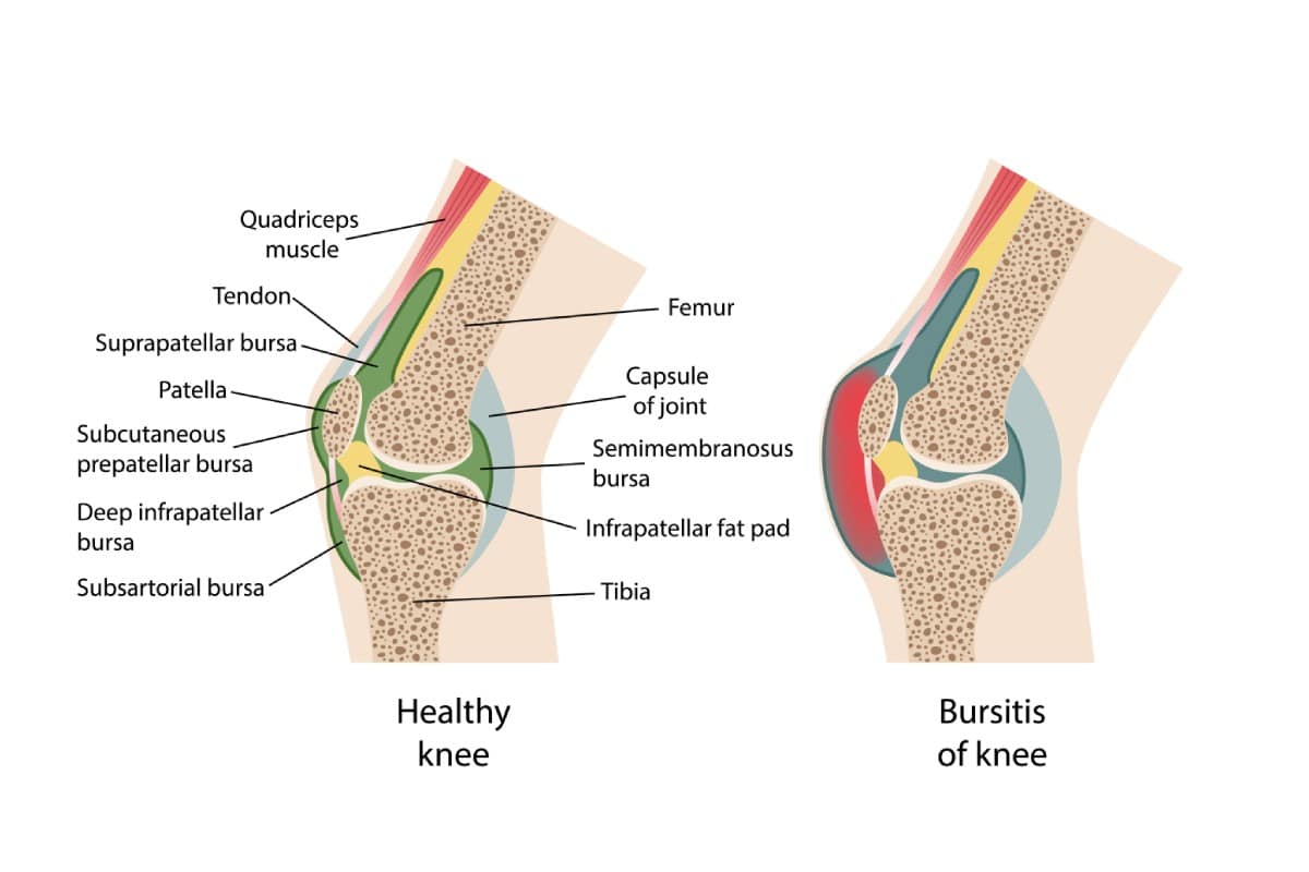 Knee Bursitis singapore