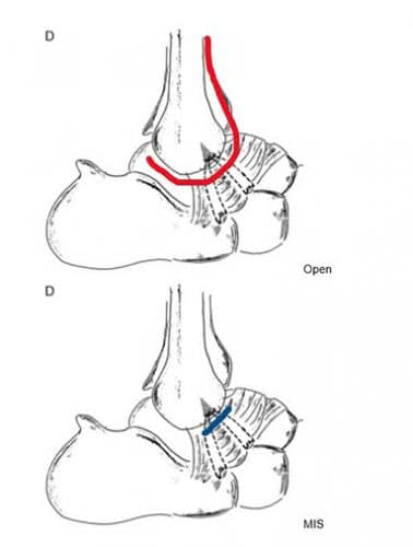 MIS laso technique ankle ligament restoration