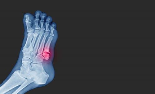 Metatarsal Fracture