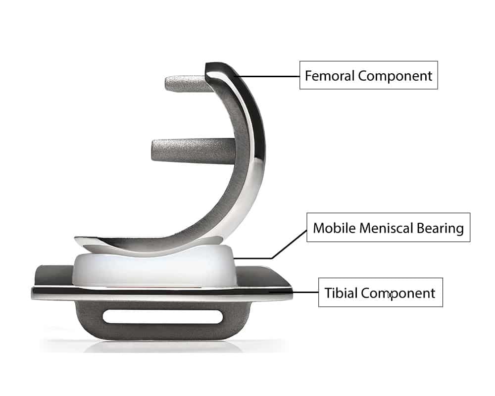 Oxford Partial Knee Replacement components