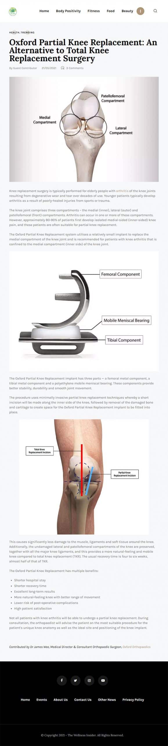 Oxford partial knee replacement feature at The Wellness Insider Asia