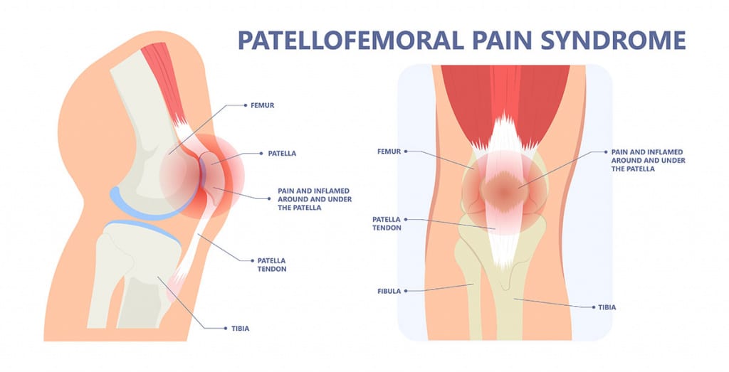Patellofemoral pain syndrome (Runners’ knee)
