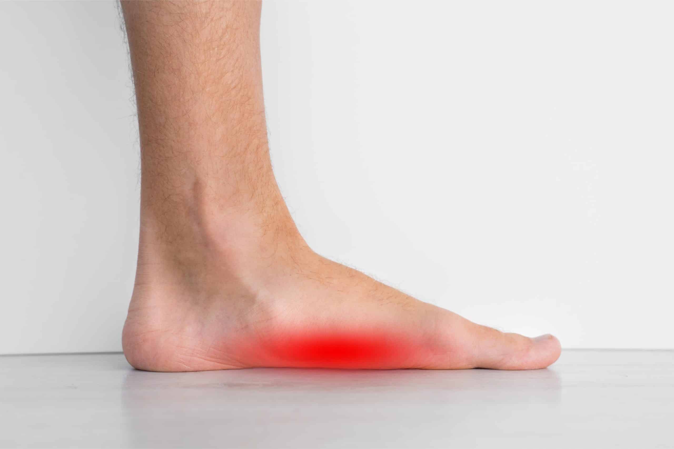 Pes Planus (Flat Foot)