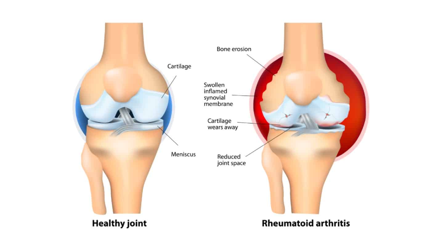 Rheumatoid Arthritis vs healthy joint
