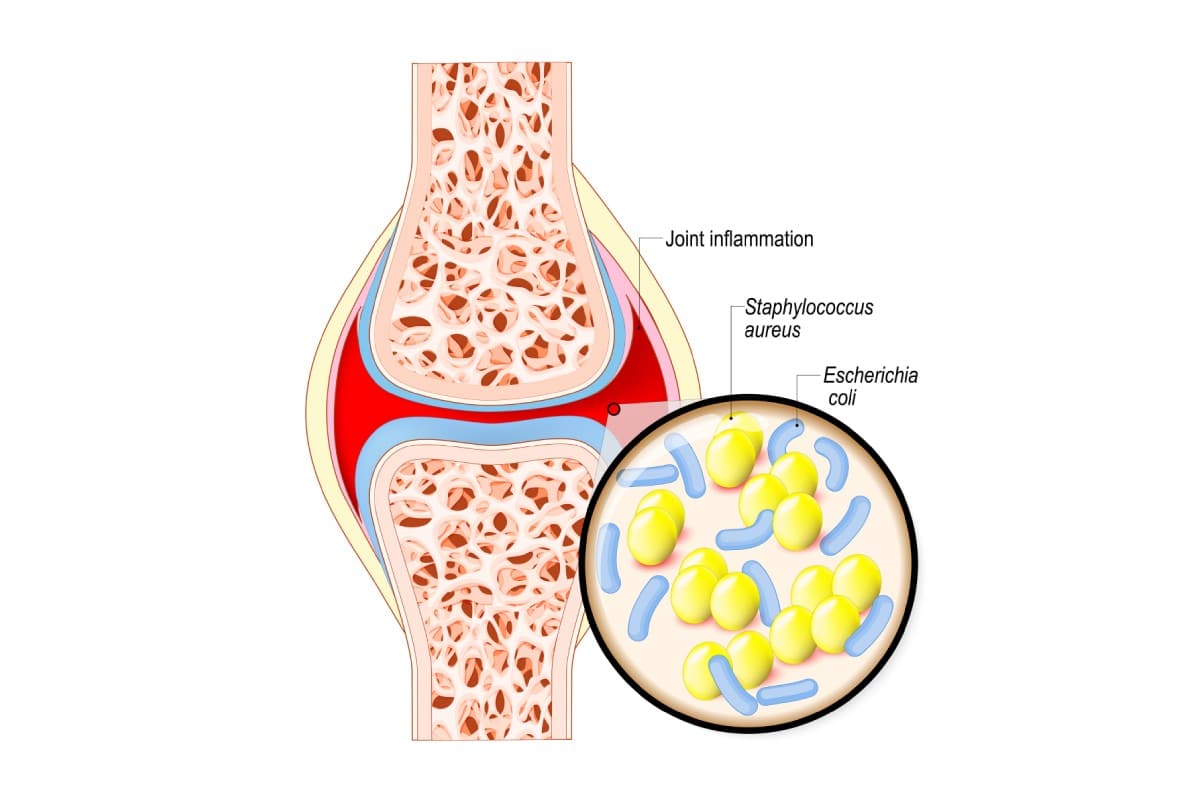 Septic arthritis infection