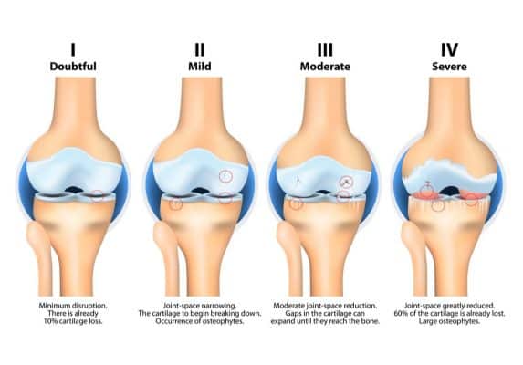 The 4 Stages of Osteoarthritis