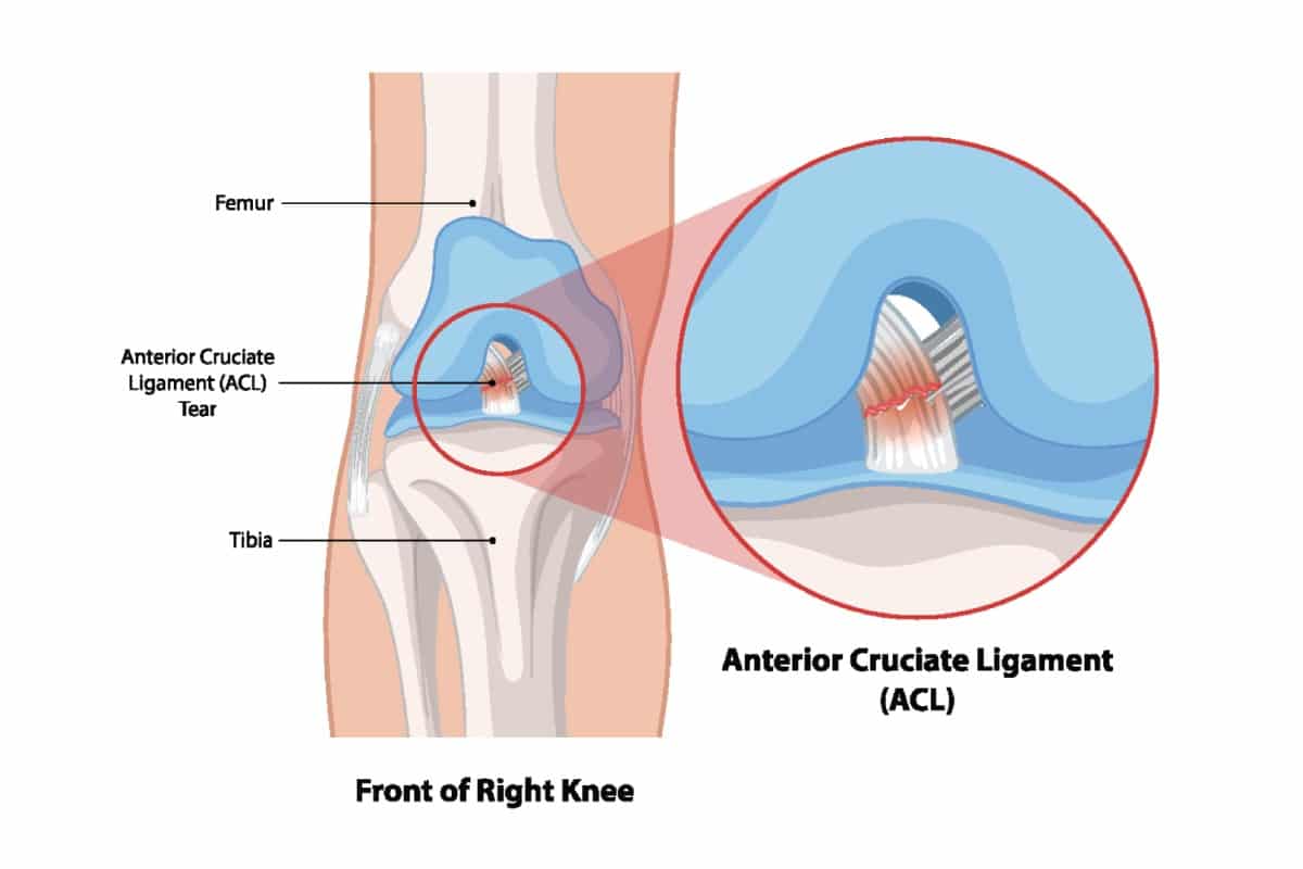acl tear treatment