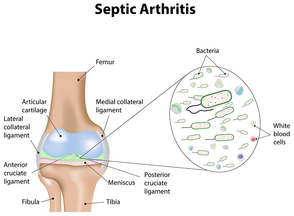 ankle septic arthritis