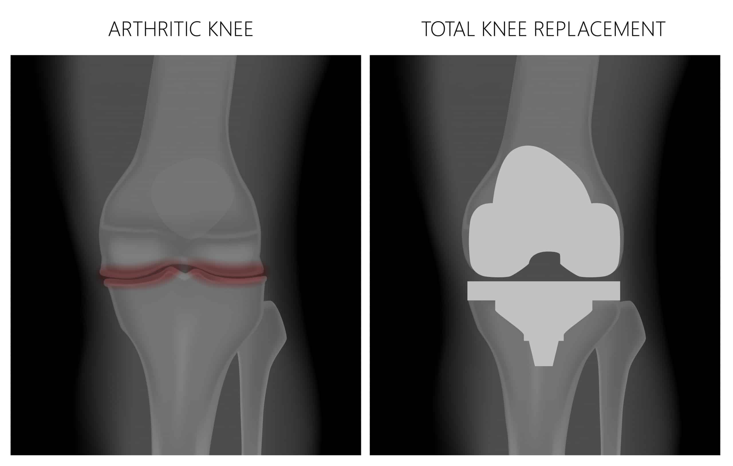 arthritic knee vs total knee replacement