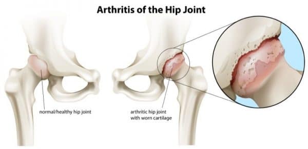 arthritis of the hip joint