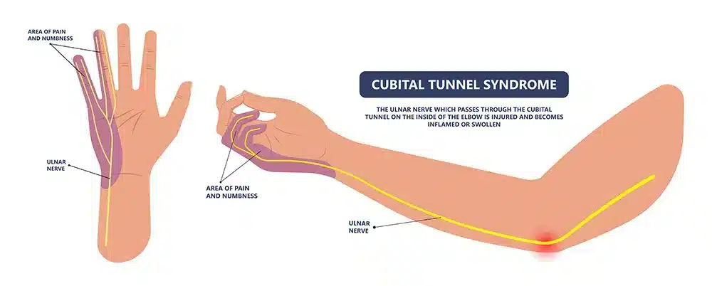 cabital tunnel syndrome