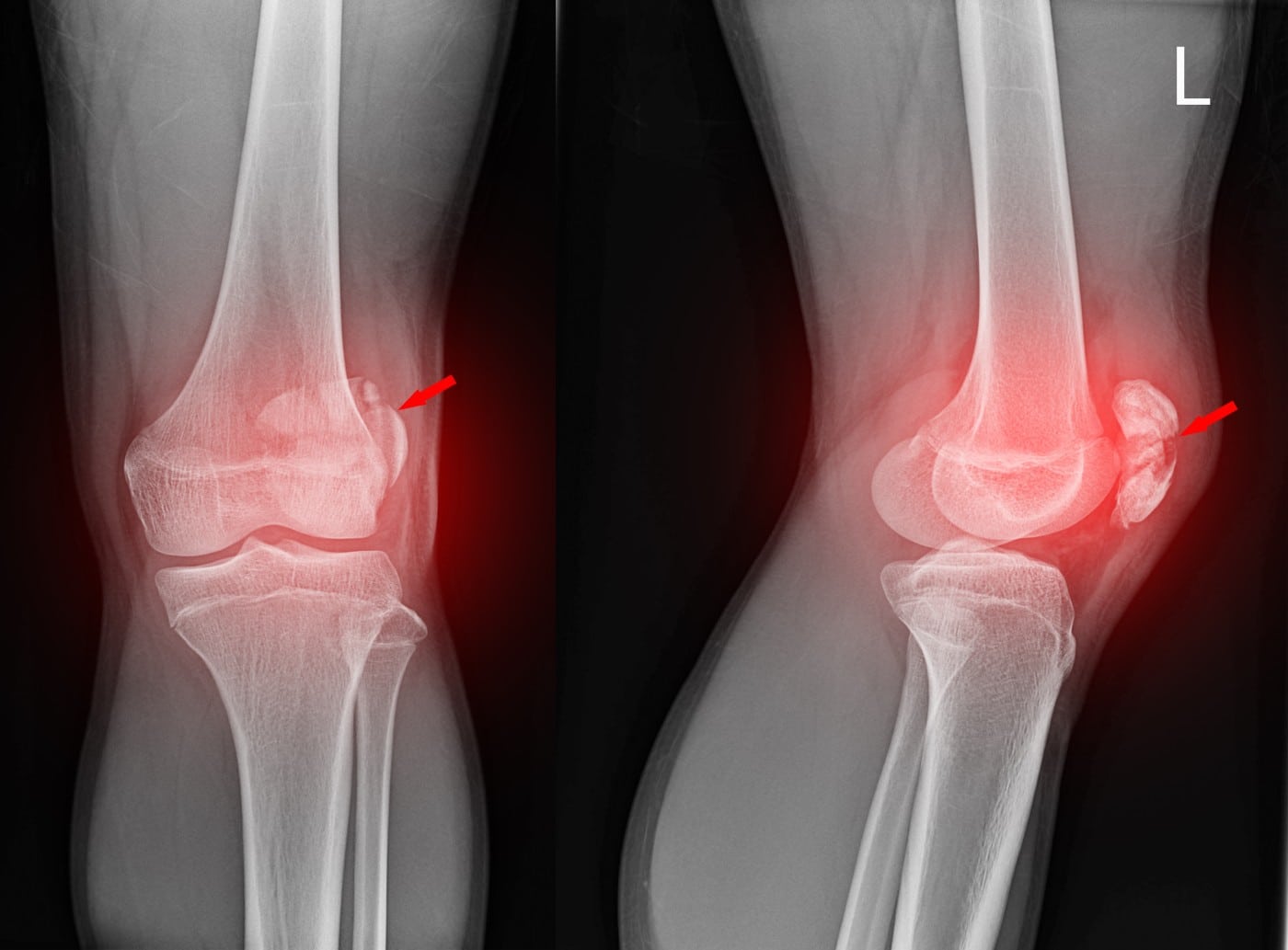 complex knee fractures knee injury