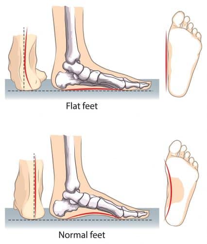 flat feet vs normal feet