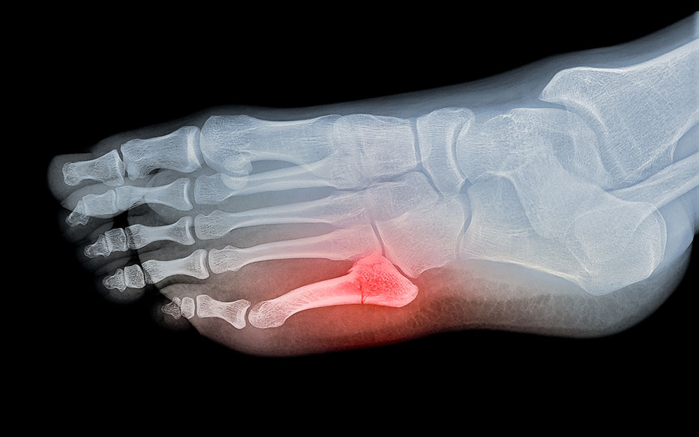 foot xray diagnosis