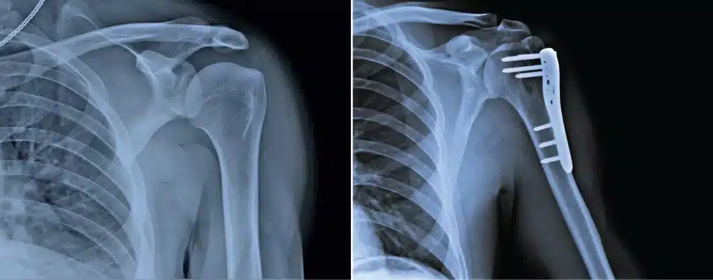 fracture metalpins in the shoulder proximal hHumerus