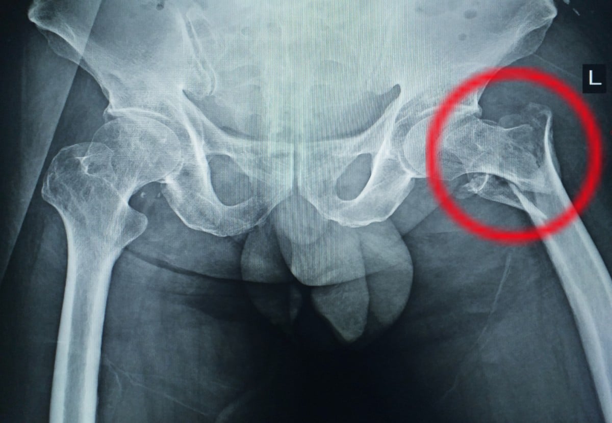 hip fracture hip arthroscopy surgery singapore