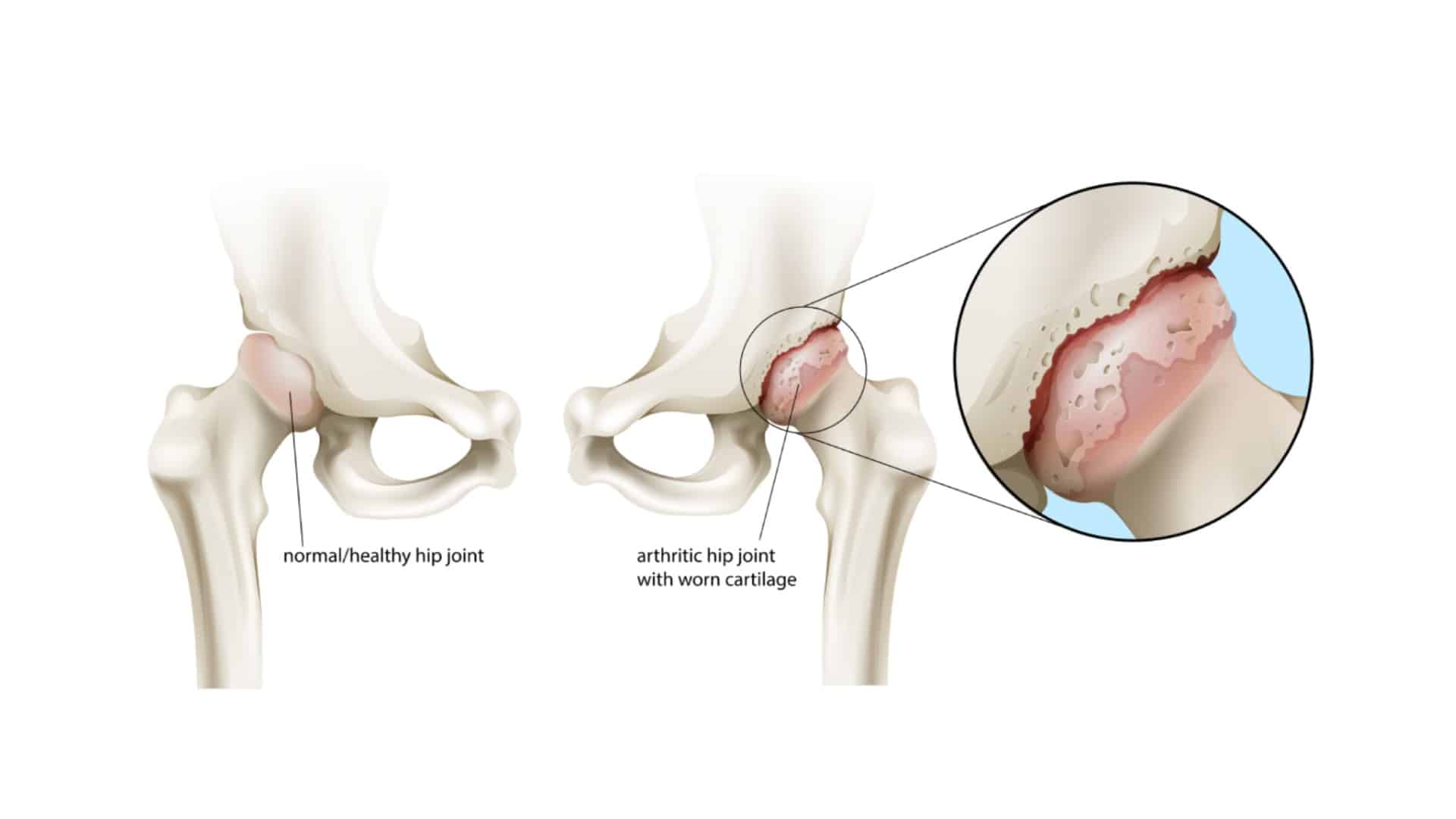hip osteoarthritis ortho singapore