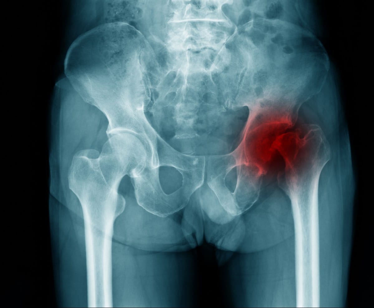 hip rheumatoid arthritis treatment singapore
