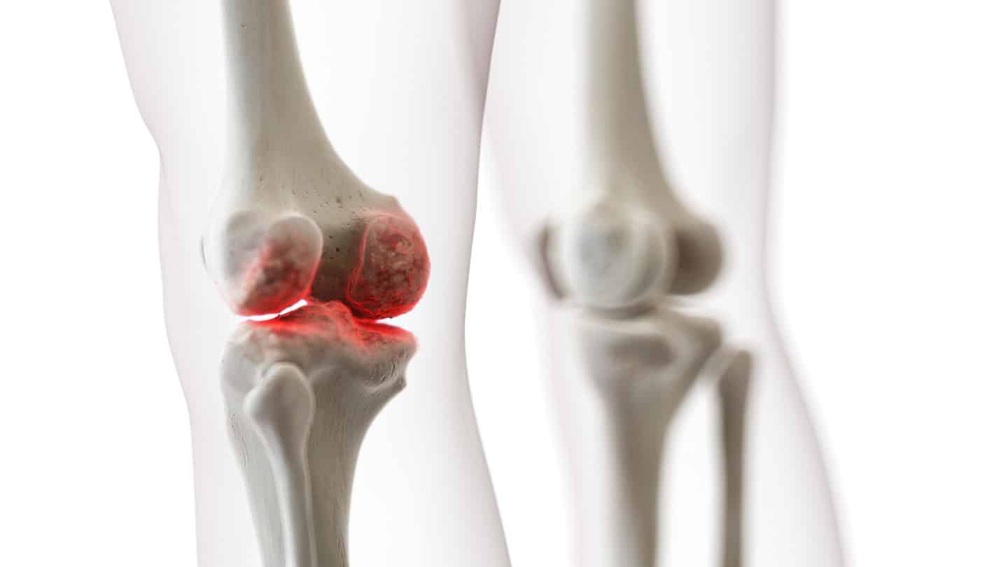 knee Cartilage Injury singapore