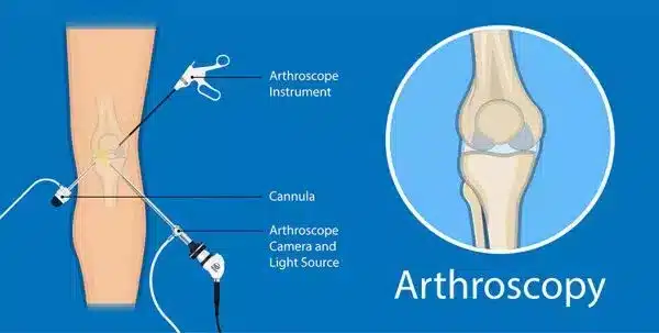 knee arthroscopy singapore