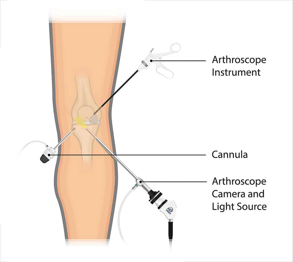 knee ligament tear treatment singapore