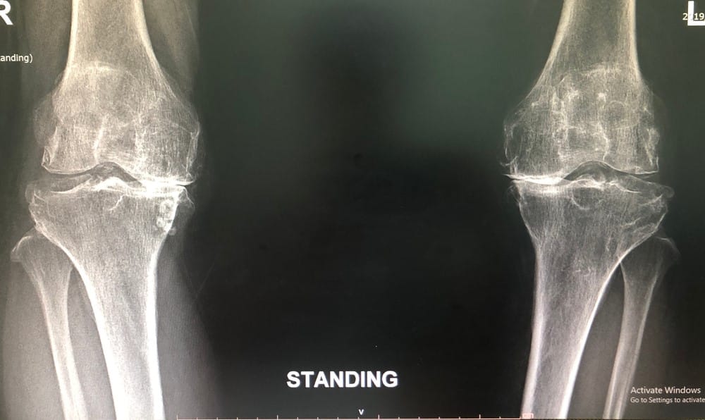 knee osteoarthritis xray diagnosis