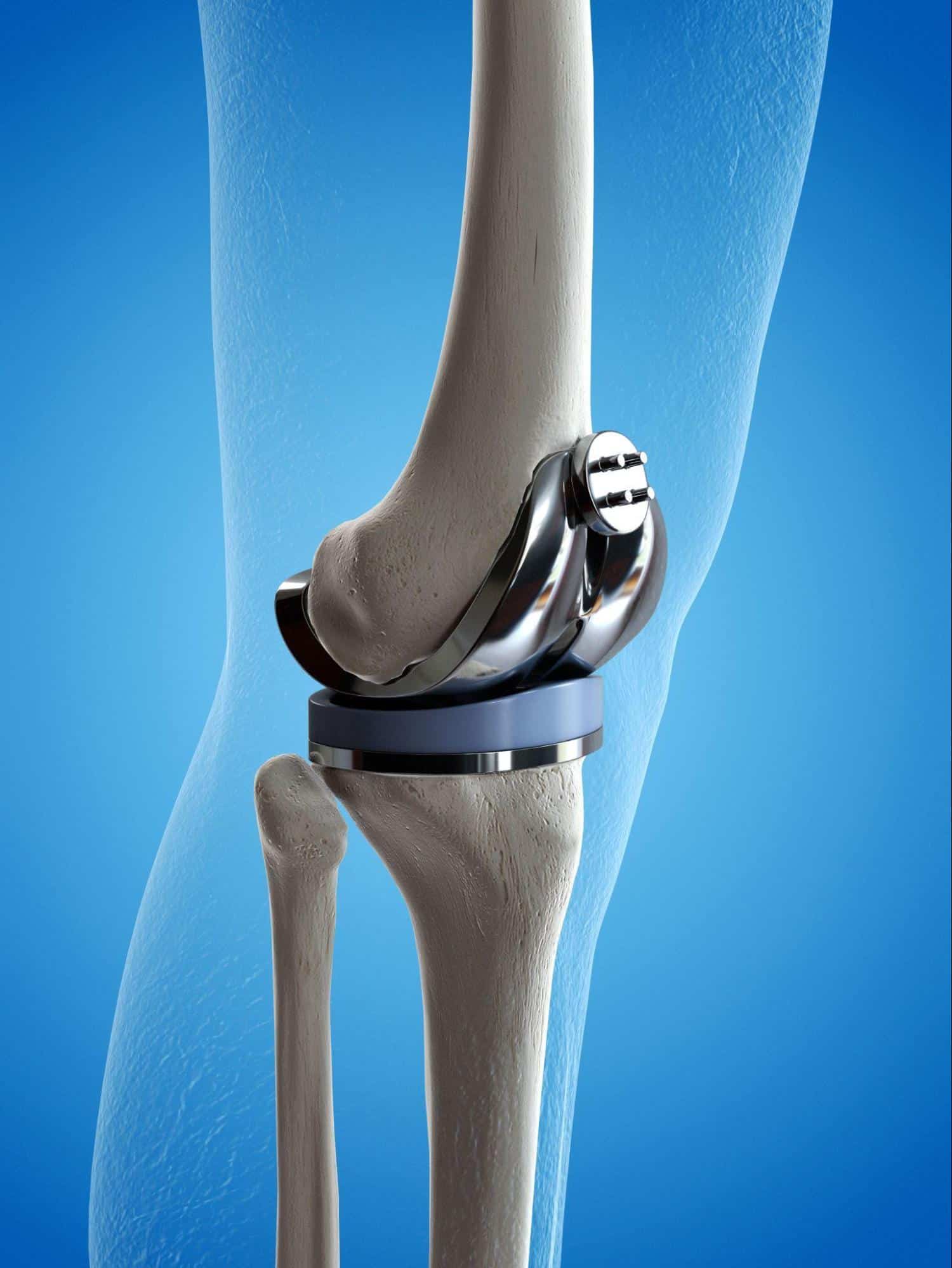 knee replacement singapore 