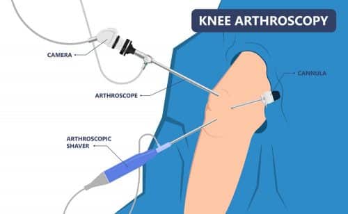 knee replacement surgery singapore arthroscopy keyhole surgery